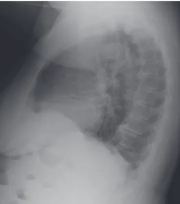 Figura 2  Radiografia simples de coluna cervical em perfil mos- mos-trando calcificação difusa de ligamento longitudinal anterior e  áreas de calcificação de ligamento longitudinal posterior