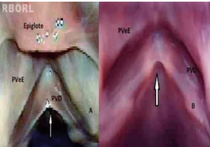 Figura 1   Microdiafragma laríngeo (seta). A figura A, refere-se  à laringe 52, e a figura B, refere-se à laringe 54 (PVeE, prega  vestibular esquerda; PVD, prega vocal direita).