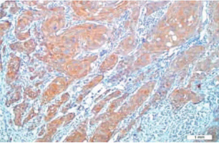 Figura 1   Coloração citoplasmática de FCEV em carcinoma de  células escamosas (× 200).