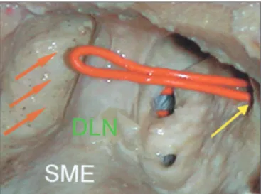 Figura 2.  Visão lateral de dissecção de seio maxilar esquerdo do tipo  ANT (anterior)