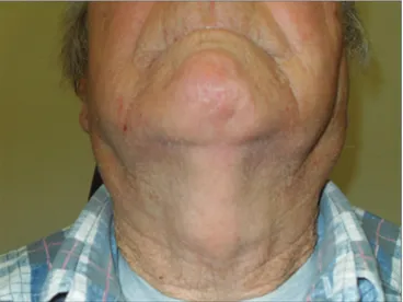 Figura 1.  Paciente com aumento parotídeo bilateral e lipossubstituição  na ressonância magnética.