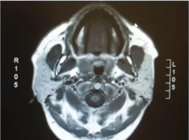 Figura 2.  Corte axial em T1 sem contraste mostrando hiperssinal em  parótidas.