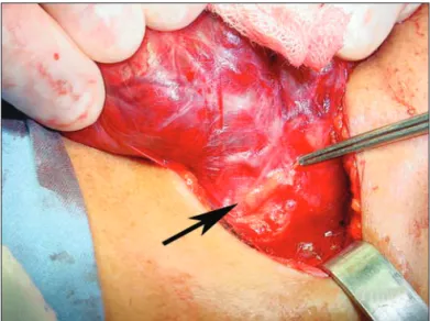 Figura 1.  Identificação extracapsular de glândula tireoide no campo  operatório.