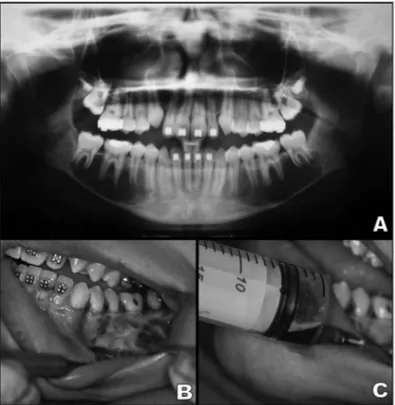 Figura 1.   A: Radiografia panorâmica mostrando uma lesão  multilocular bilateral com festonamento ao longo das raízes dentárias  na região posterior da mandíbula