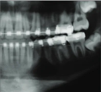 Figura 3.  Cisto ósseo traumático no corpo mandibular esquerdo  com padrão multilocular, dando à lesão uma aparência tumoral