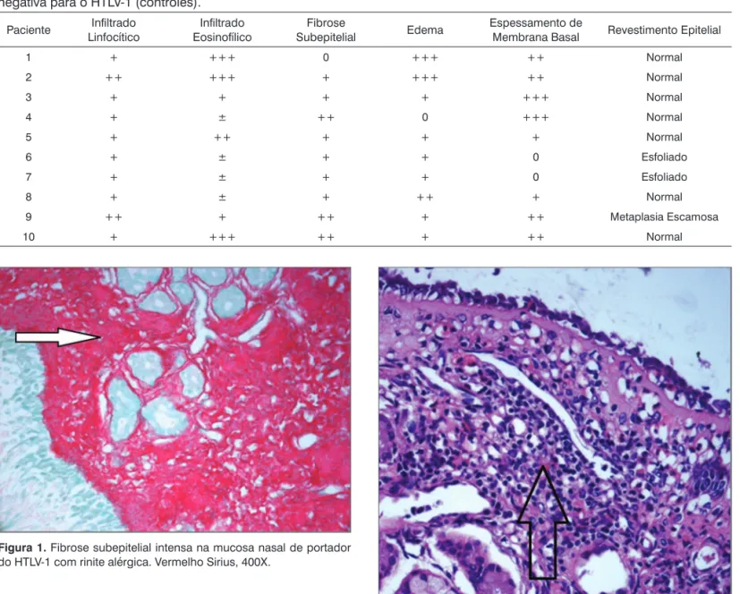 Figura 2.  Discreta fibrose subepitelial na mucosa nasal de paciente  com rinite alérgica não infectado pelo HTLV-1