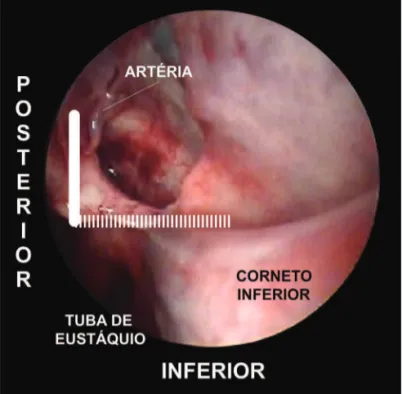 Figura 5.  Fotografia  da  fossa  nasal  esquerda.  O  limite  inferior  do 