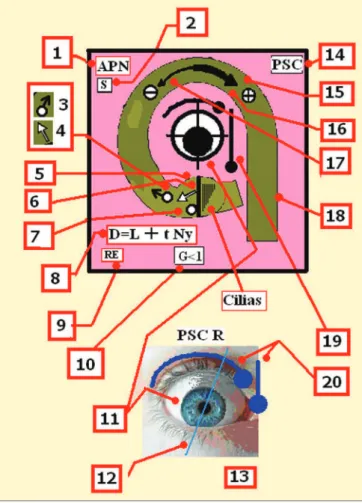 Figura 4. Via Central - Siglas na Figura 3: FLO: Flóculo cerebelar, SVN:  Núcleos Vestibulares Superiores, MVN: Núcleos Vestibulares Mediais,  MLF: Fascículo Longitudinal Medial, UBN: Nistagmo para cima (violeta),  NVI: Nistagmo para baixo (vermelho), NT: 