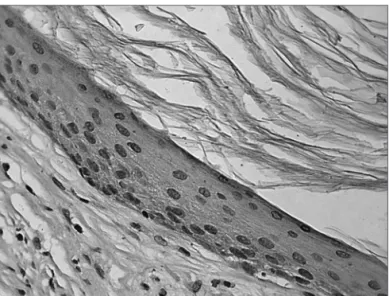 Figura  1.   Fotomicrografia  de  fragmento  de  colesteatoma  onde  se  observa reação fraca ao anticorpoTNF-R2 no citoplasma dos  querati-nócitos da matriz (IHQ X400).