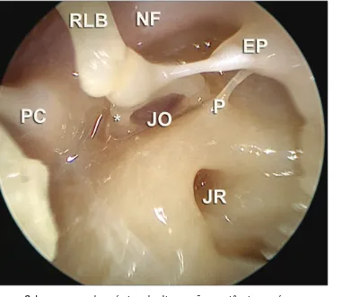 Figura 6.  Imagem endoscópica de dissecção anatômica após a remo- remo-ção timpânica, com instrumento de 30 graus de angularemo-ção, mostrando  o tipo de imagem que pode ser obtida com acessos endoscópicos