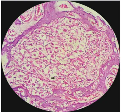 Figura  11.   Alterações  generalizadas  nas  células  da  estria  vascular,  sem definição da organização celular e aspecto da membrana  ves-tibular de cobaia tratada com cisplatina na dose de 3mg/kg por seis  dias consecutivos