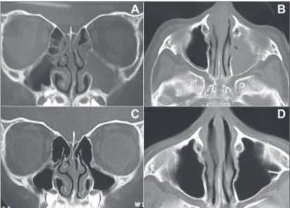 Figura 3.  Tomografia computadorizada pré e pós-operatória (exame  realizado 6 meses após a cirurgia) de paciente submetido à sinuplastia