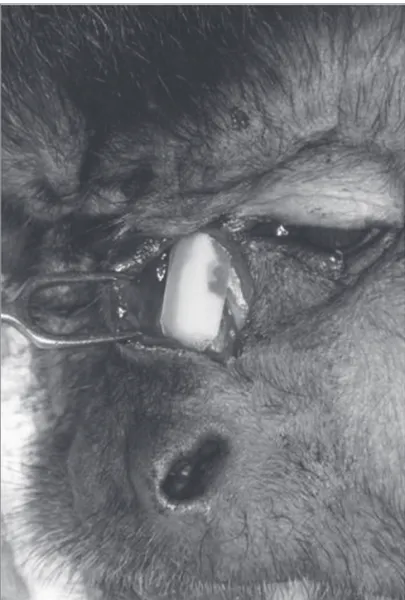Figura 2.  Aspecto do transoperatório mostrando fratura dos ossos  nasais.