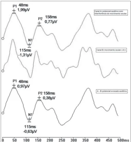 Figura 1.  Registro dos potenciais evocados auditivos de longa latência  pelo método de Controle do Limite de Rejeição - (ms - milissegundos,  æV - microvolt).