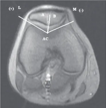 Figura  1.  Ângulo	 do	 sulco	(AS),	formado	 entre	as	 facetas	 lateral	e	