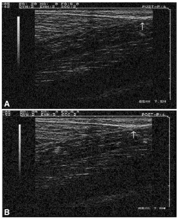 Figura 1.  Posição da junção miotendínea do gastrocnêmio medial 