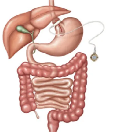 Figura 4 - Gastrectomia vertical 