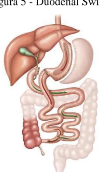 Figura 5 - Duodenal Switch 