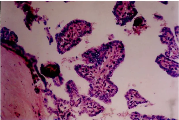 Figura 10 - Estudo histológico de paciente portador de carcinoma papilífero tipo folicular 