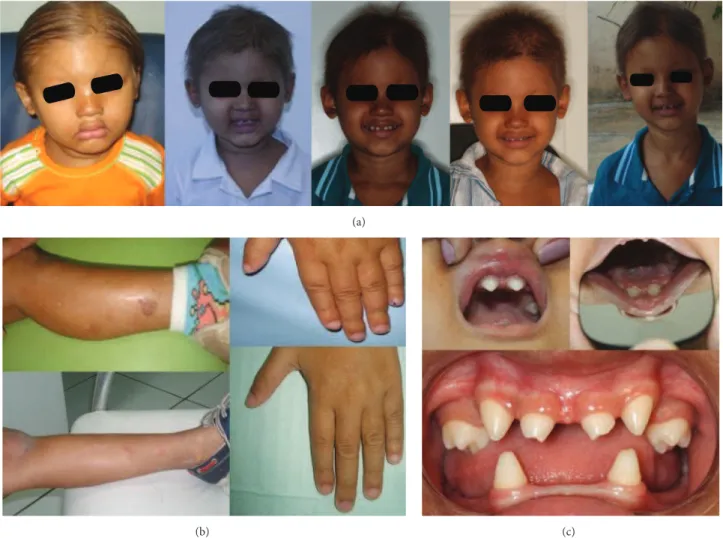 Figure 1: (a) Patient’s visage at 2, 3, 4, 5, and 6 years of age with sparse hair, frontal bossing, saddle nose, and everted prominent lips