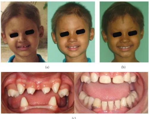 Figure 4: Patient before and ater treatment. (a) Initial and inal facial aspect. (b) 12 months ater the installation of the prosthesis
