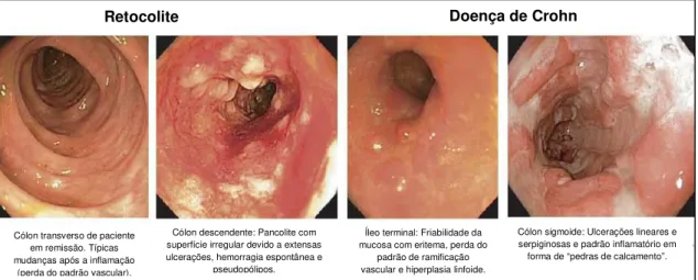 Figura 2 – Imagens adquiridas por meio de colonoscopia demonstrando o aspecto  morfológico das lesões na Retocolite ulcerativa e na Doença de Crohn