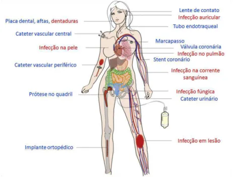 Figura 3 – Infecções comumente associadas a biofilmes de C. albicans.  Infecções decorrentes  do uso de aparatos médicos colonizados por biofilmes (azul) e infecções locais ou sistêmicas  causadas por biofilmes (vermelho)