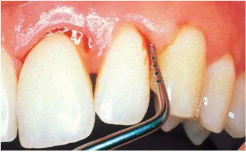 FIGURA 6 - Procedimento para aferição da profundidade de sondagem de bolsa  periodontal no sítio distovestibular do incisivo lateral em paciente com PC