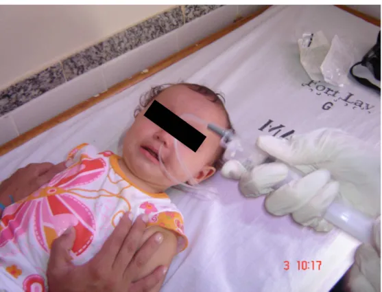 FIGURA 5 – Coleta de secreção de nasofaringe em criança atendida no HIAS.  