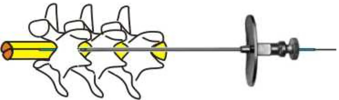 Figura 4 - Esquema ilustrativo do sítio de inserção da agulha através do espaço intervertebral entre  L5 e L6 e da localização do cateter de polietileno para administração intratecal