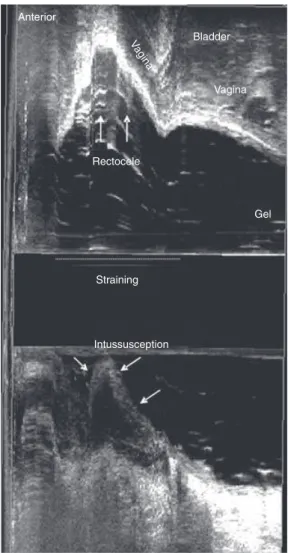 Table 1 Comparison of dynamic 3-DAUS (echodefaecography) with defaecography in the detection of perineal descent.