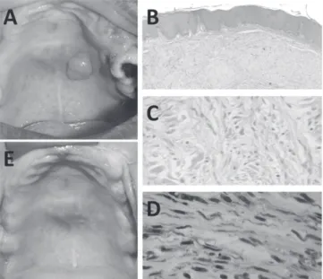 Figura 1 Neuroibroma isolado em palato. A, Aspecto clínico  inicial da lesão. B,  Fotomicrograia mostrando a presença de  um tumor benigno não encapsulado, composto por proliferação  de células fusiformes com núcleo ondulado