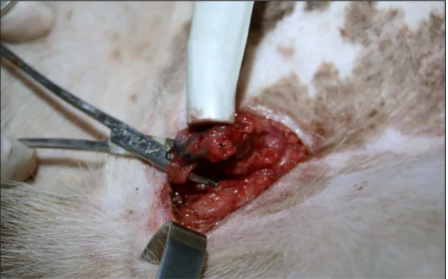 Fig. 12: Incisão e localização do linfonodo com visualização do azul patente e auxílio do aparelho gama- gama-probe em LS da região inguinal