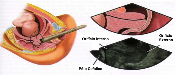 Figura 2 – Esquema de mensuração do colo através da ultra-sonografia transvaginal 