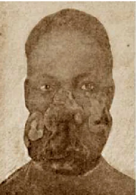 FIGURA  1 -  Reprodução de aquarela, apresentada por Carneiro da Cunha em 1912 à  Sociedade  Brasileira de Dermatologia, ilustrando caso de LTA por ele observado em 1906 (Vale ECS &amp; Furtado 