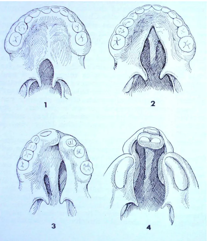 FIGURA 2 - Ilustração dos vários tipos de fissura palatal. 1- Fissura pós-forame incisivo  imcompleta; 2- Fissura pós-forame completa; 3- Fissura forame unilateral e 4- Fissura  trans-forame bilateral, segundo a classificação de Spina (SPINA; LODOVICI, 197
