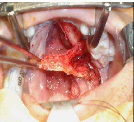 FIGURA 9 – Descolamento do retalho mucoperiosteal, ficando o retalho aderido pelo feixe  vásculo-nervoso palatino