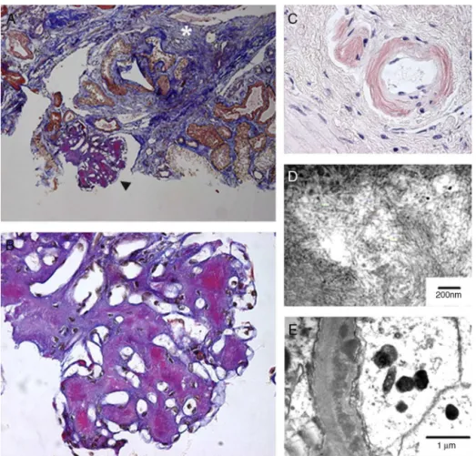 Table 1 summarizes previous reports on kidney involve- involve-ment in visceral leishmaniasis.