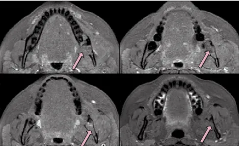 Fig 4. Inferosuperior axial T1-weighted magnetic resonance images (MRIs) showing the intermediate signal  intensity of the lesion (arrows) and its real limits