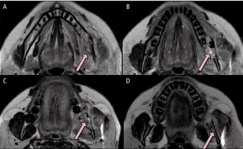 Fig 5. Inferosuperior axial T2-weighted MRIs. A, C, and D. Lesion (arrows). B. Hypersignal area of the  lesion (arrow)