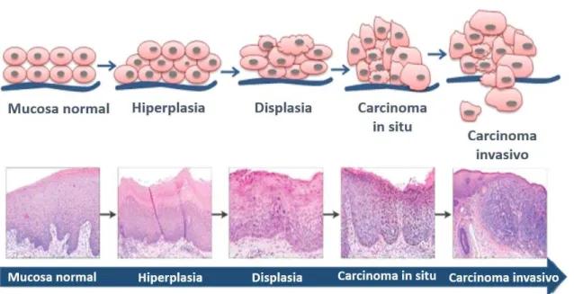 Figura 1 - Esquema de progressão de mucosa normal para carcinoma 