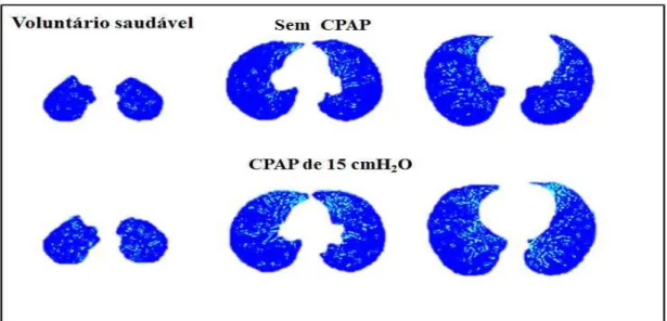 Figura 7: Efeitos da aplicação do CPAP de 15 cmH 2 O em imagens de TCAR.  