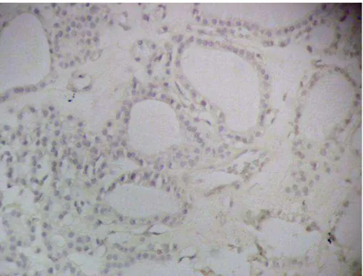 Figura 10. Marcação do adenoma folicular com HBME-1 (200X): Ausência de marcação nas  células foliculares