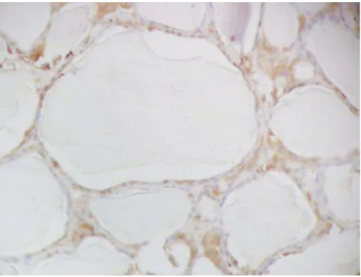 Figura  13.  Marcação  do  adenoma  de  células  de  Hürthle  com  373E1  (200X):  Ausência  de  marcação nas células foliculares