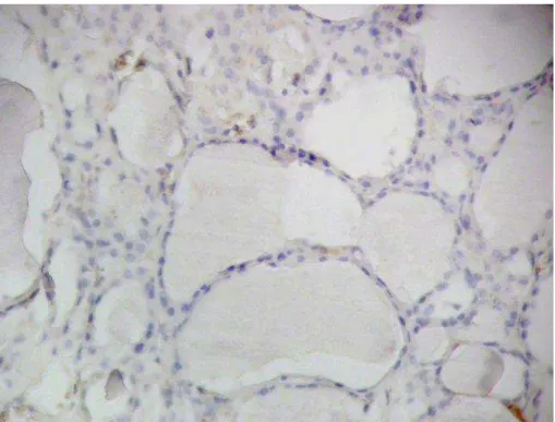 Figura  15.  Marcação  do  adenoma  de  células  de  Hürthle  com  CK19  (200X):  Ausência  de  marcação nas células foliculares