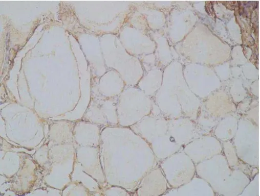 Figura  17.  Marcação  do  bócio  com  FTL-B  (100x):  Ausência  de  marcação  nas  células  foliculares com moderada marcação de fundo