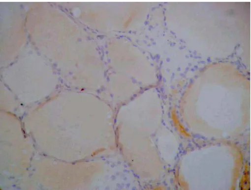 Figura  20.  Marcação  do  bócio  com  GAL3  (200X):  Ausência  de  marcação  nas  células  foliculares com moderada marcação de fundo em colóide