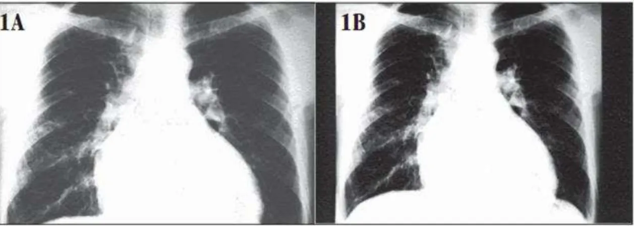 Figura 3  –  1A - Exame radiológico de tórax (out/1994) de paciente chagásico, quando  iniciou  dispneia