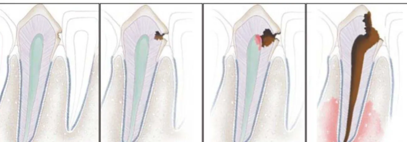 Figura 5: Esquema demonstrador da progressão da Cárie Dental 
