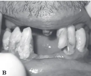 Figura 3. Estado clínico da cavidade bucal de idoso com 62 anos.